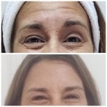 До і після ін'єкцій філерів у Clinica Granado Tiagonce, зменшення зморшок навколо очей