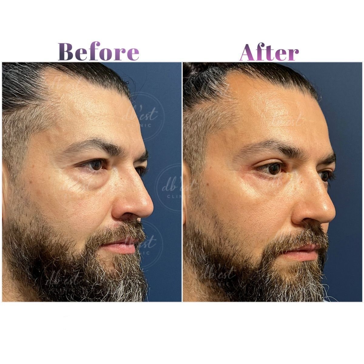 نتائج رأب الجفن قبل وبعد في Db'est Clinic – تقليل الانتفاخات تحت العين للرجل