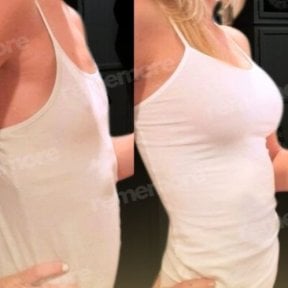 Before and after breast lift results at Memorial Şişli Hospital, enhanced breast contour