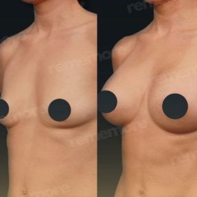Before and after breast lift results at Memorial Şişli Hospital, improved breast contour