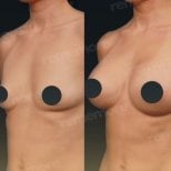 Before and after breast lift results at Memorial Şişli Hospital, improved breast contour