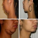 Vorher-nachher-Ergebnisse Kinn-Liposuktion bei LaCLINIQUE of Switzerland, verbesserte Kontur