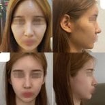 Результаты до и после коррекции челюсти в VG Plastic Surgery, улучшен овал лица и симметрия