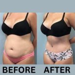 Before and after tummy tuck and liposuction results at ID Clinic Bangkok, flatter abdomen