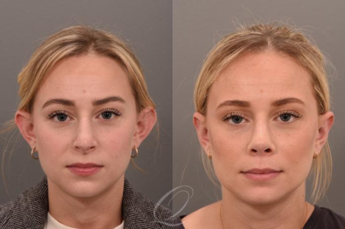 Before and after otoplasty results at Veselibu Clinic – improved ear shape and symmetry