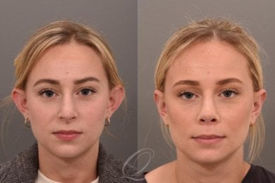 Resultados de otoplastia antes y después en Veselibu Clinic – mejora de forma y simetría de orejas