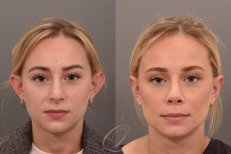 Resultados de otoplastia antes y después en Veselibu Clinic – mejora de forma y simetría de orejas