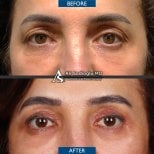 Vorher-nachher-Ergebnis der Ober- und Unterlidchirurgie in der Dr. Safa Manav Klinik