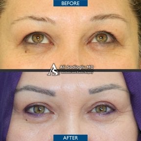 Vorher-nachher-Ergebnis der Ober- und Unterlidstraffung in der Dr. Safa Manav Klinik
