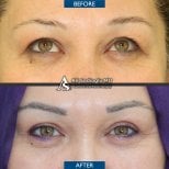 Vorher-nachher-Ergebnis der Ober- und Unterlidstraffung in der Dr. Safa Manav Klinik