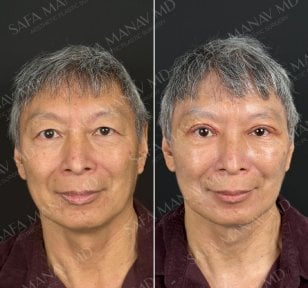 Vorher-nachher-Ergebnisse der Ober- und Unterlidchirurgie in der Dr. Safa Manav Klinik