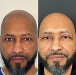 Vorher-nachher-Ergebnis Ober- und Unterlidstraffung in der Dr. Safa Manav Klinik