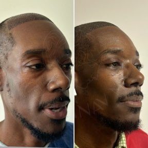 Vorher-nachher-Ergebnisse FUE-Haartransplantation bei Dr. Safa Manav Clinic, verbesserter Haaransatz