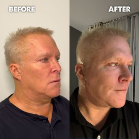 Vorher-nachher-Ergebnis der Brauenlifting bei Dr. Safa Manav Clinic, sichtbare Stirnstraffung