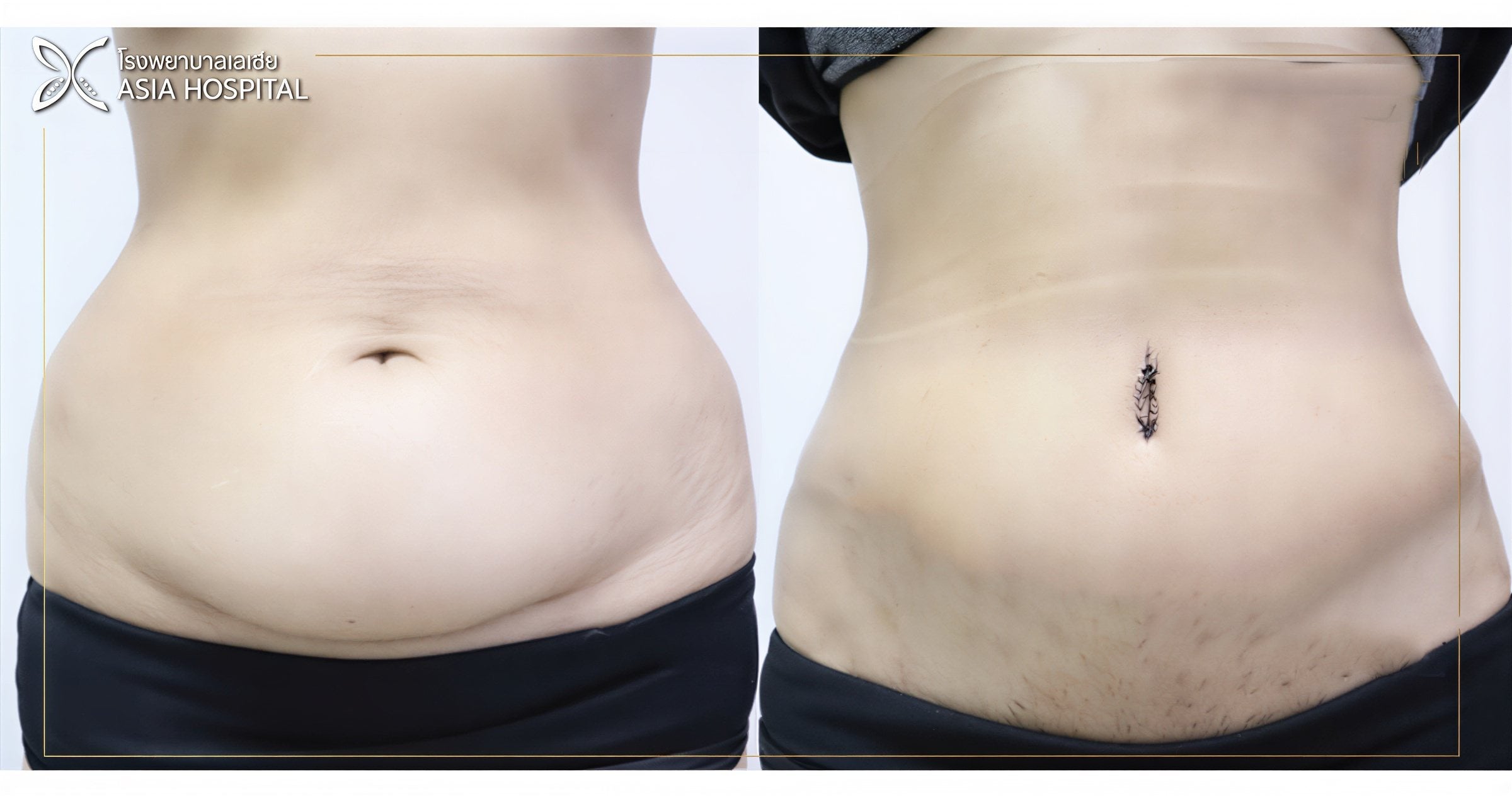 Resultados antes y después de Vaser 3 áreas más abdominoplastia en Asia Cosmetic Hospital, abdomen plano