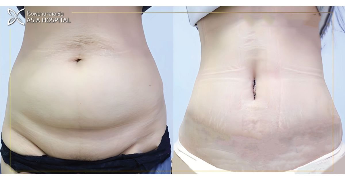 Resultados antes y después de Vaser 3 áreas más abdominoplastia en Asia Cosmetic Hospital, abdomen plano