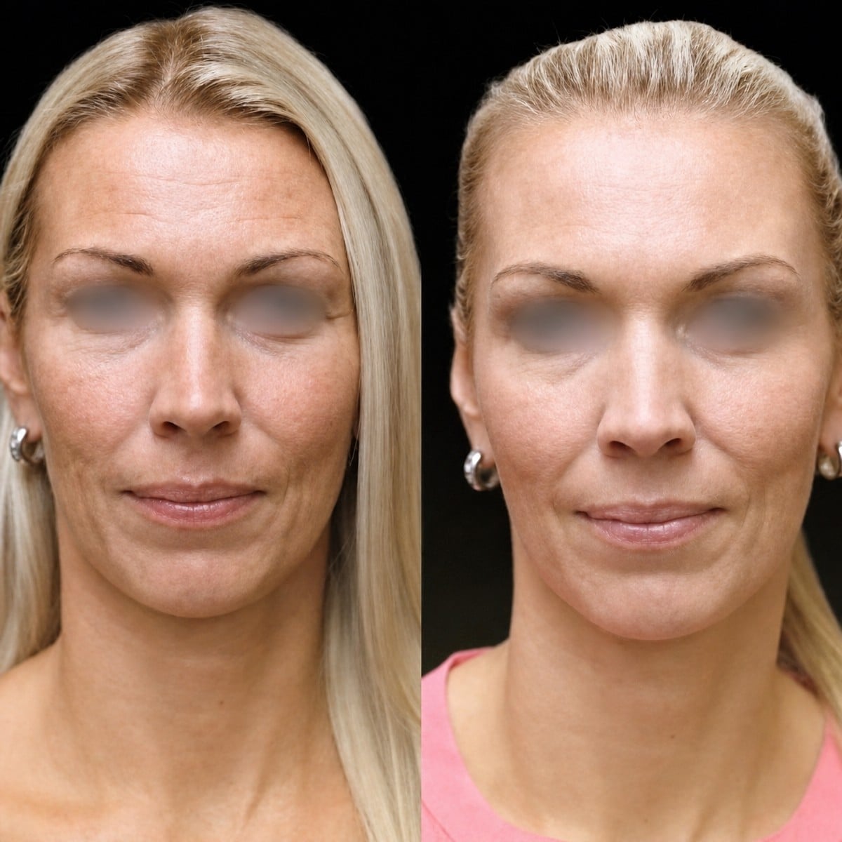 Resultados de transferencia de grasa facial antes y después en Memorial Şişli Hospital