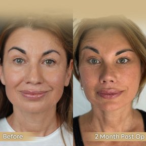 Facelift Vorher-Nachher-Ergebnis in der Dr. Safa Manav Klinik, 2 Monate nach OP