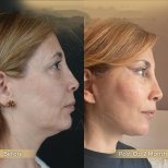 Facelift Vorher-Nachher-Ergebnis in der Dr. Safa Manav Klinik, verbesserte Gesichtskontur