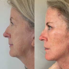 Facelift Vorher-Nachher-Ergebnisse in der Dr. Safa Manav Klinik, sichtbare Straffung