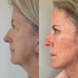 Facelift Vorher-Nachher-Ergebnisse in der Dr. Safa Manav Klinik, sichtbare Straffung