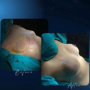 نتائج شد الثدي قبل وبعد في عيادة TWT Health Clinic، تحسين شكل الثدي