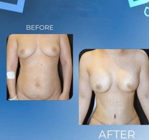نتائج شد الثدي قبل وبعد في TWT Health Clinic، تحسين شكل الثدي وتحديده