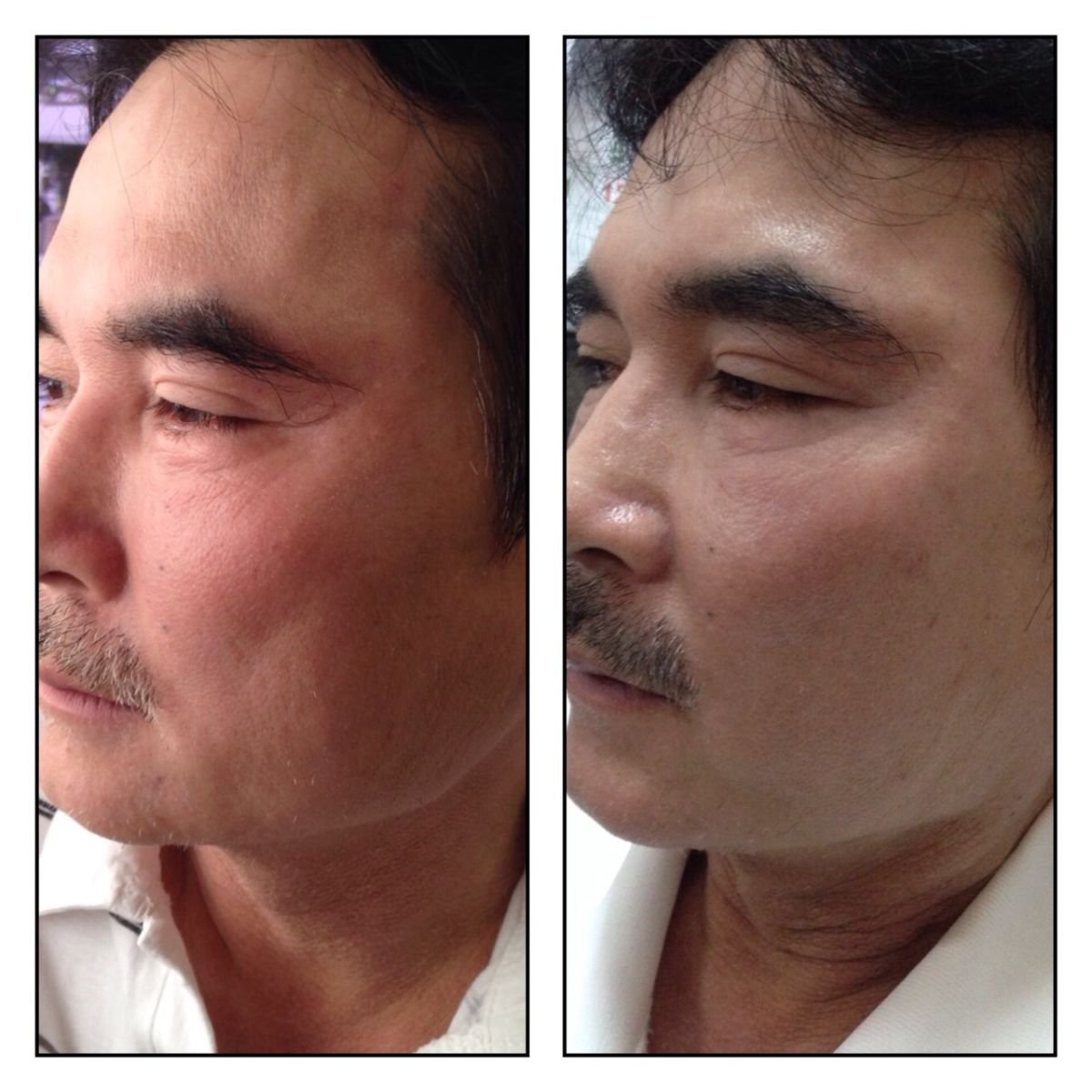 Resultados de Ultherapy antes y después en Asia Cosmetic Hospital, reafirmación facial visible