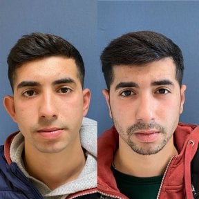 Before and after otoplasty results at Avicenna International Hospital, ear reshaping surgery