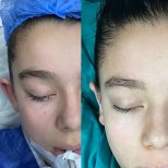 Otoplastik Vorher-Nachher-Ergebnis bei Avicenna International Hospital, Ohrenkorrektur