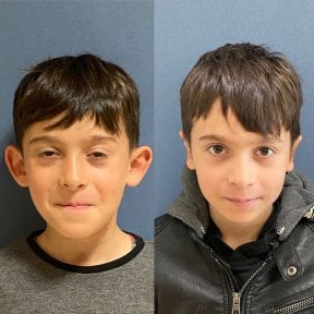 Before and after otoplasty results at Avicenna International Hospital, ear reshaping surgery