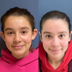 Before and after otoplasty results at Avicenna International Hospital, ear surgery correction