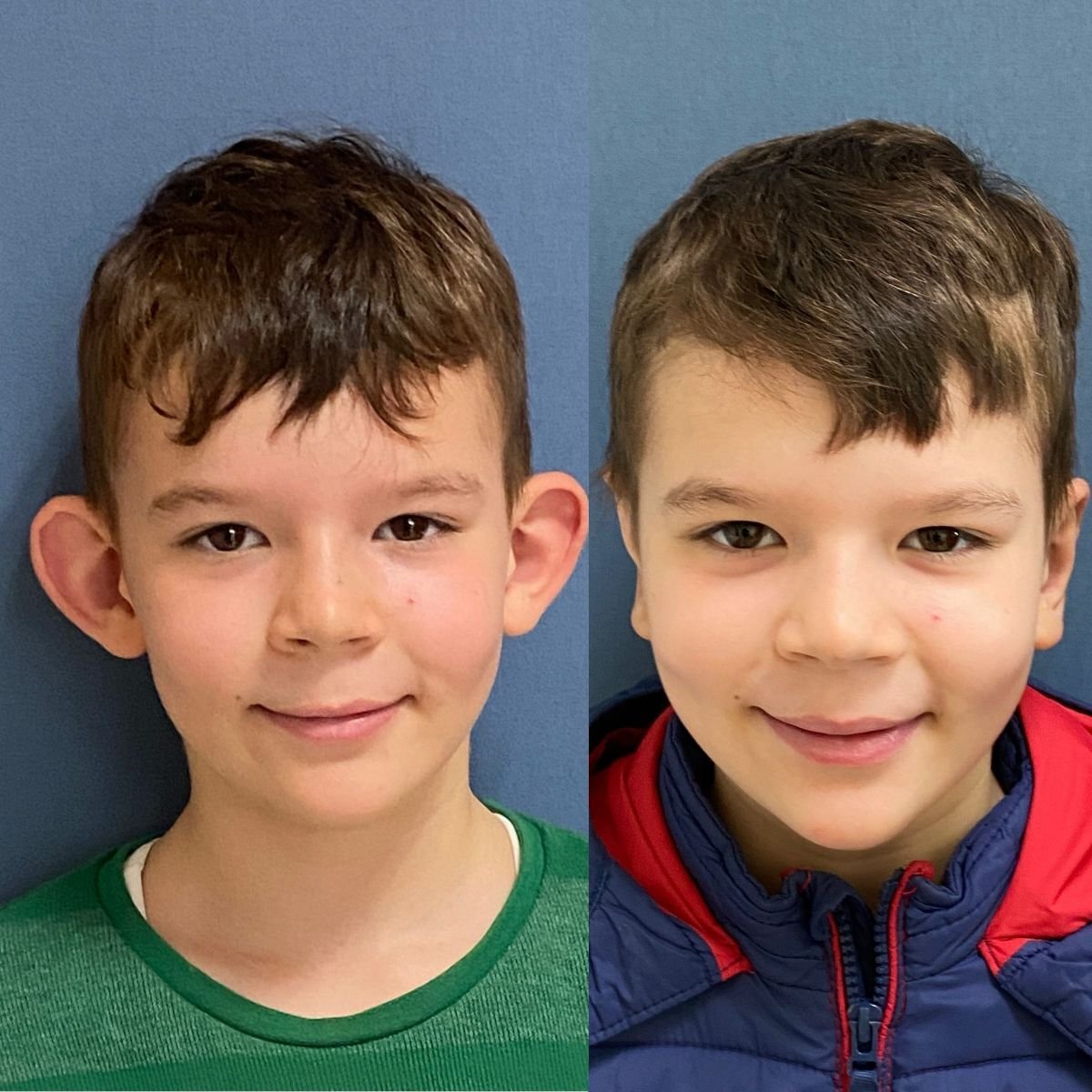 Vorher-nachher-Otoplastik-Ergebnisse in der Avicenna International Hospital, Ohrenkorrektur