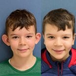 Before and after otoplasty results at Avicenna International Hospital, ear reshaping surgery