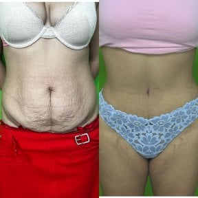 Résultats avant et après liposuccion à la clinique esthétique Prof. Karabekmez