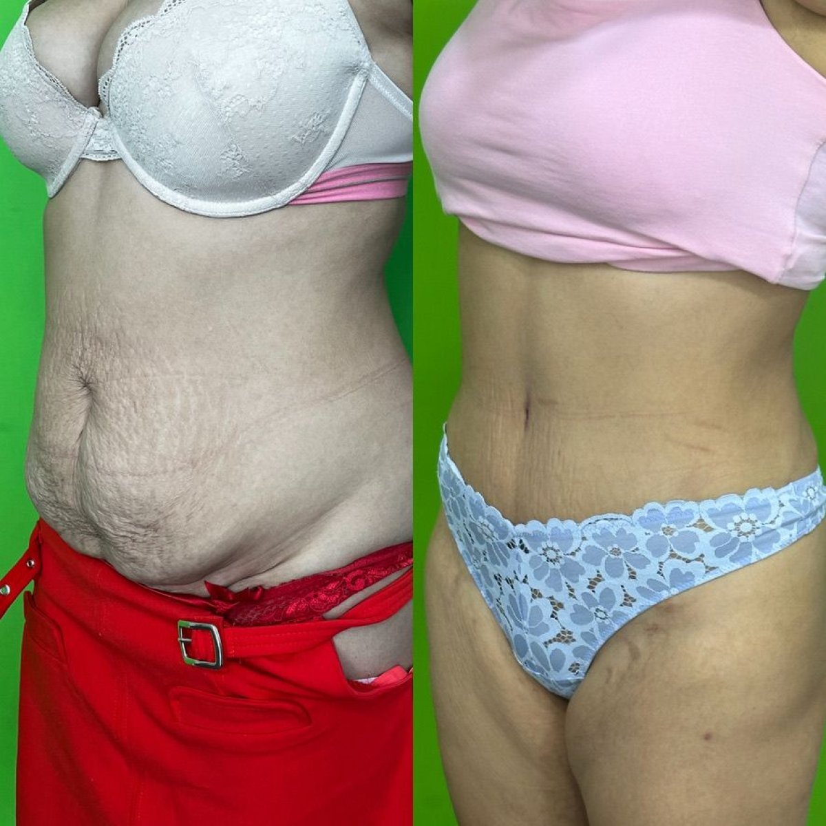 Результаты липосакции до и после в клинике эстетической хирургии проф. Карабекмеза