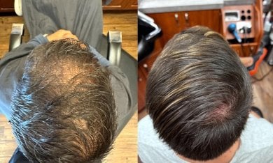 Before and after stem cell hair treatment results at Immunotherapy Regenerative Medicine clinic