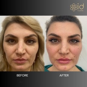 Before and after hyaluronic acid threads lifting result at ID Clinic Bangkok, facial rejuvenation