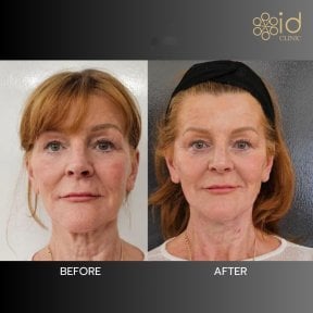 Before and after Hyaluronic Acid Threads Lifting result at ID Clinic Bangkok, facial rejuvenation