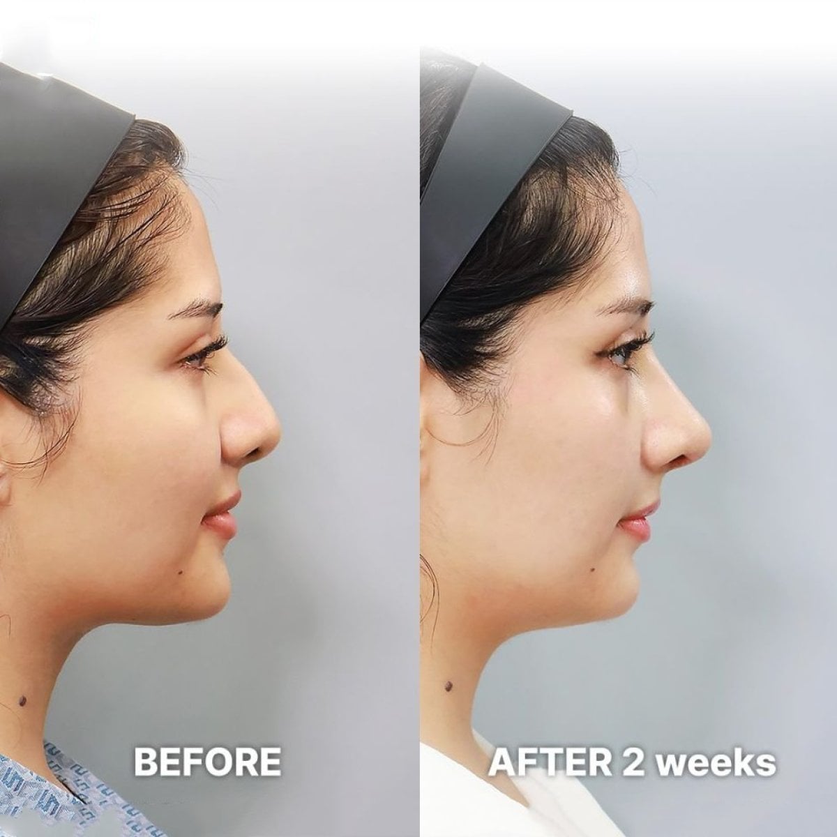 Resultados de alarplastia antes y después en Returning Plastic Surgery, mejora nasal en 2 semanas