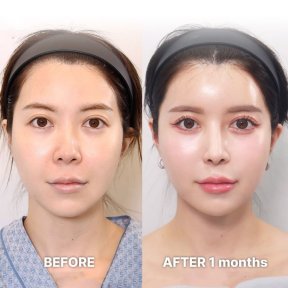 Vorher-nachher-Ergebnis der Alarplastik bei Returning Plastic Surgery, verbesserte Nasenform