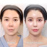 Vorher-nachher-Ergebnis der Alarplastik bei Returning Plastic Surgery, verbesserte Nasenform