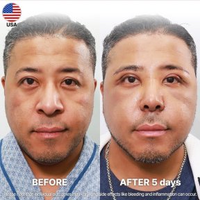 Vorher-nachher-Ergebnis der Alarplastik bei Returning Plastic Surgery, sichtbare Nasenkorrektur nach 5 Tagen