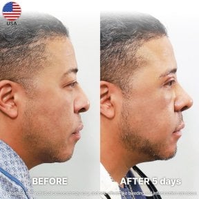 Vorher-nachher-Ergebnis der Alarplastik bei Returning Plastic Surgery, Nase nach 5 Tagen