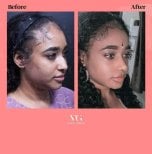 Результаты до и после ультразвуковой ринопластики в VG Plastic Surgery, видна коррекция носа