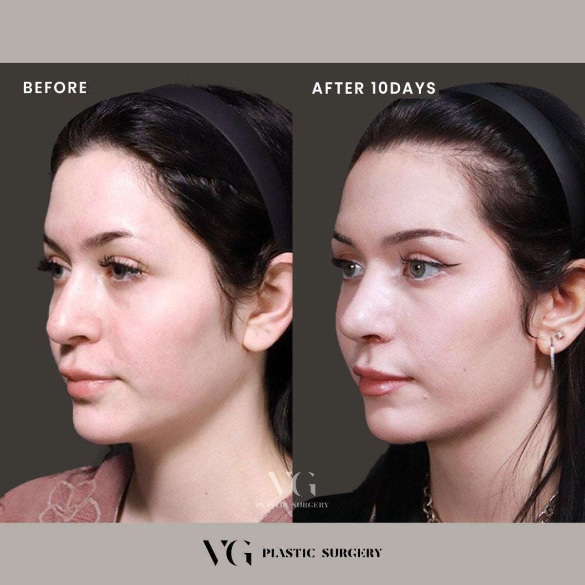 نتيجة قبل وبعد تجميل الأنف بالموجات فوق الصوتية في VG Plastic Surgery، إعادة تشكيل الأنف