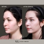 Результат до и после ультразвуковой ринопластики в VG Plastic Surgery, видна коррекция носа