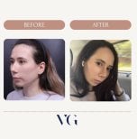Результаты до и после ультразвуковой ринопластики в VG Plastic Surgery, изменение носа