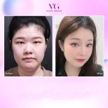 Vorher-nachher-Ergebnis der Brauenlifting bei VG Plastic Surgery, verbesserte Augenpartie