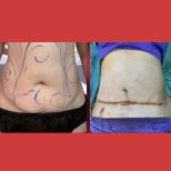 Before and after tummy tuck results at DGB Clinic, visible abdominal contour improvement